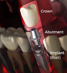 A Dental Implants structure and components 