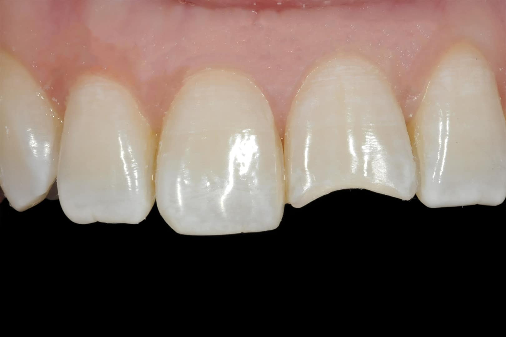 Cracked Tooth Syndrome