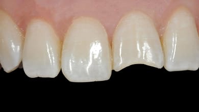 Cracked Tooth Syndrome